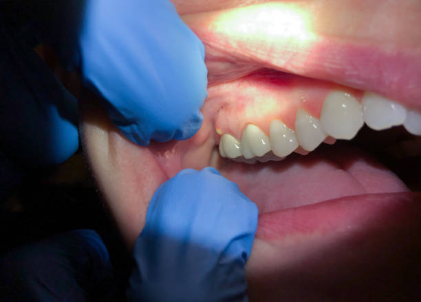 Best Emergency Wisdom Tooth Extraction in Crescent Springs, KY